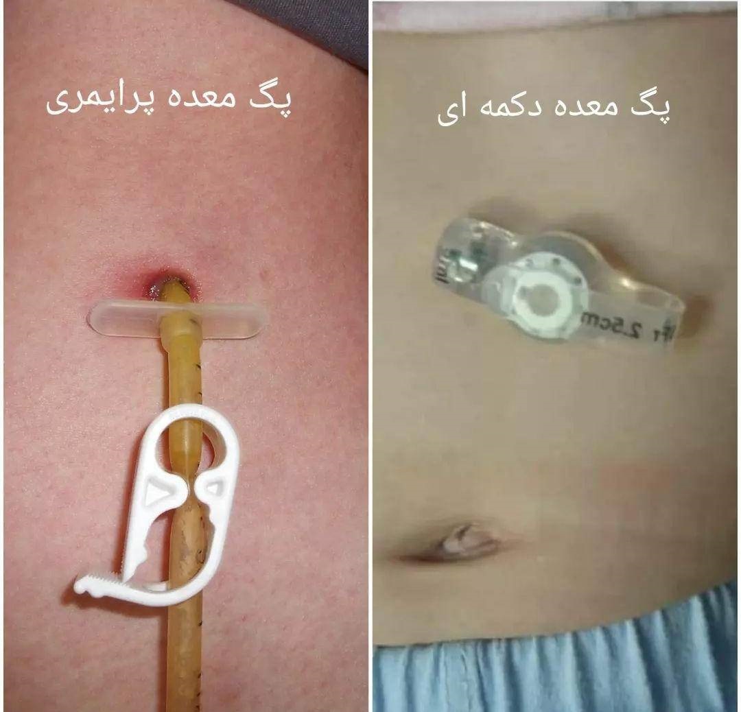  فیدینگ تیوپ لوله ایست از جنس سیلیکون و نرم که برای انتقال مواد غذایی محلول از پگ بیمار به داخل معده استفاده می کنند. این وسیله استریل و یکبار مصرف پزشکی ساخت آلمان می باشد و در سایزهای 20و22 و 24 موجود می باشد.برای تهیه این پگ احتیاج به نسخه پزشک و کد ملی می باشد.انتهای تیوپ که داخل معده قرار میگیرد دارای یک بالون می باشد که توسط آب مقطر پر می شود و باعث ثابت شدن در داخل معده بیمار میشود.بنا به توصیه سازنده حتما هر دو هفته حجم بالون چک&nbsp;شود. جهت کسب اطلاعات بیشتر و نصب ان می توانید با مشاور مرکز تماس بگیرید.شستشوی مداوم قبل و بعد از گاواژ حتما توصیه می شود.