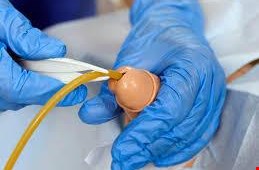 سونداژ یا جایگزاری سوند فولی 